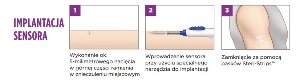diabetyk cukrzyca pomiary cukru glukozy podskórne gdzie zrobić zabieg prywatnie kraków refundacja apriori 61a