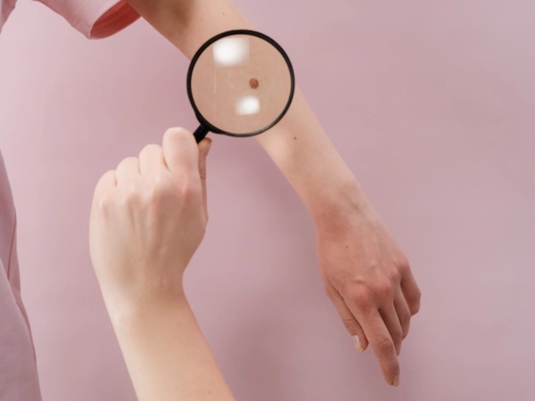 znamię podejrzane do wycięcia krakó∑ apriori zawiłą 61a chirurg zabieg prywatnie